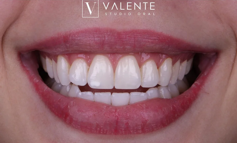 Resultado de clareamento · Valente Studio Oral