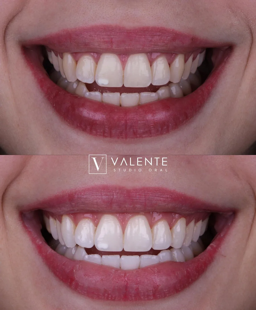 Transformação de sorriso