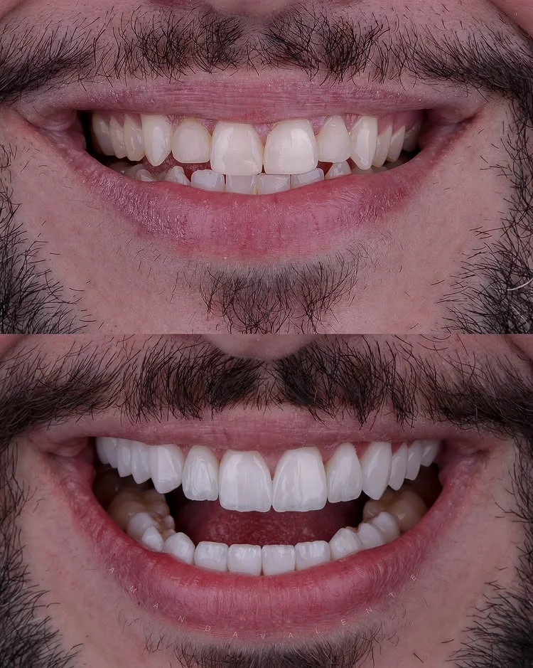 Transformação de sorriso