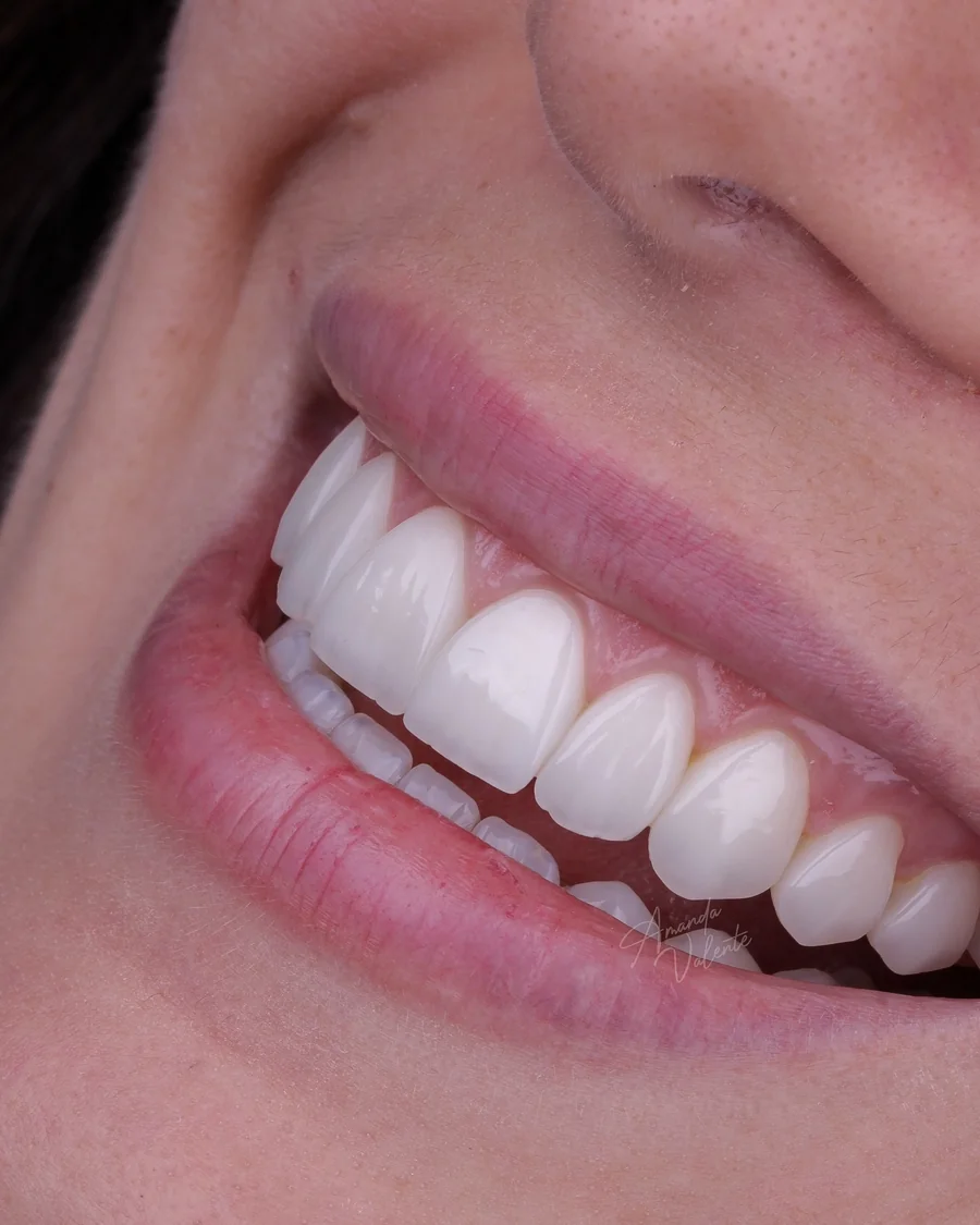 Transformação de sorriso