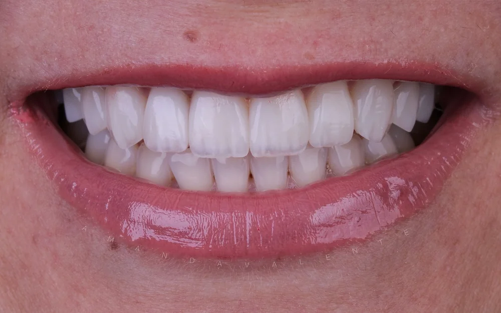 Resultado de facetas · Valente Studio Oral