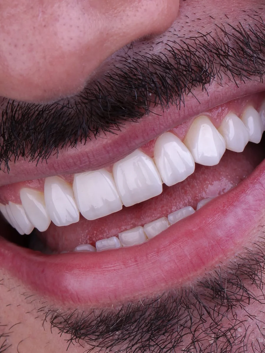 Transformação de sorriso