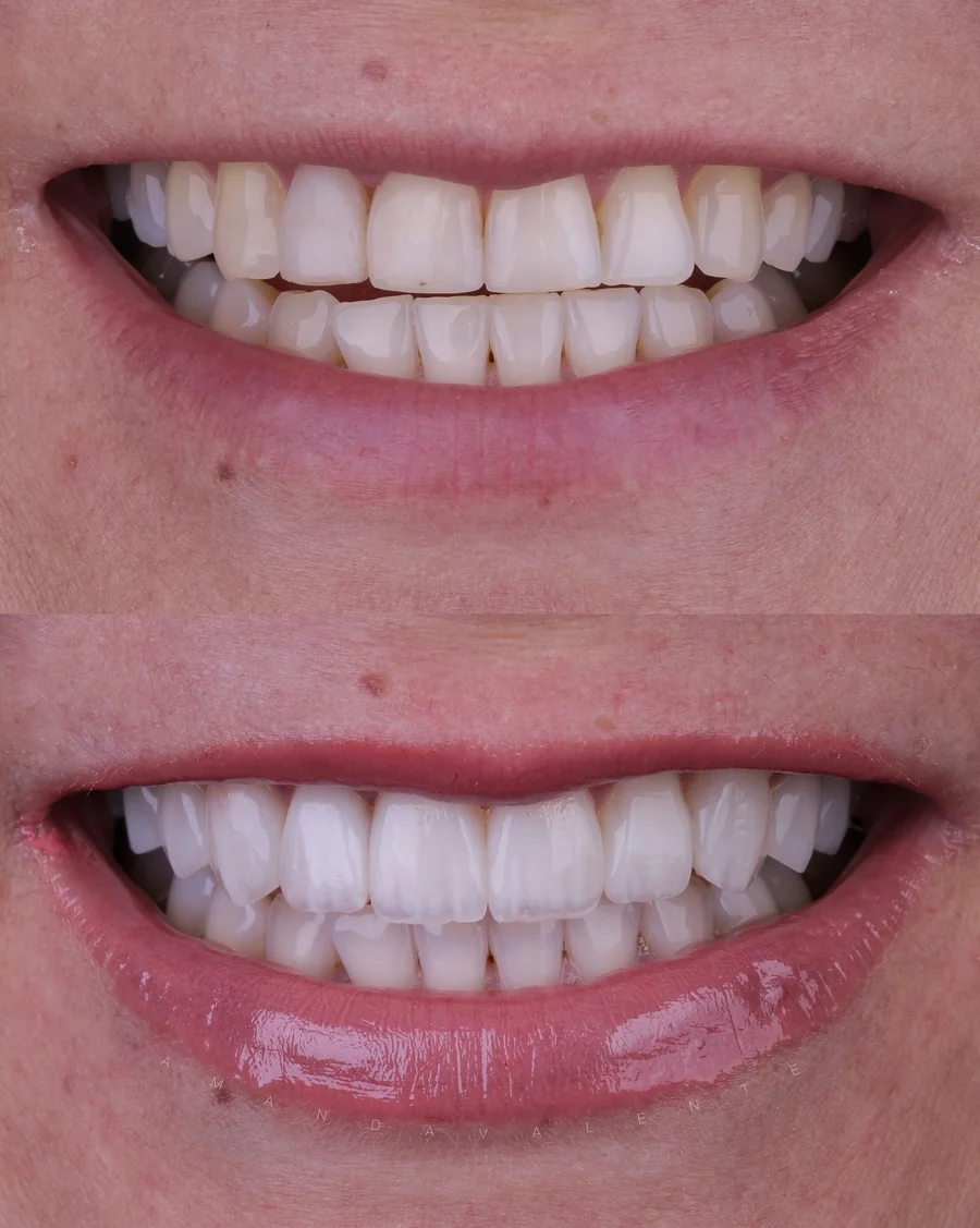 Transformação de sorriso