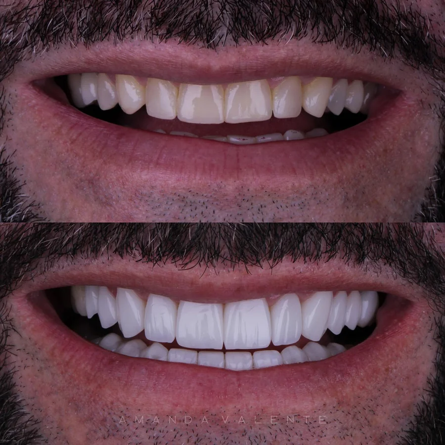 Transformação de sorriso