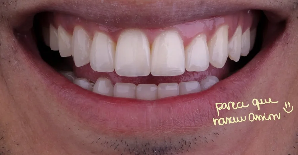 Resultado de ortodontia · Valente Studio Oral