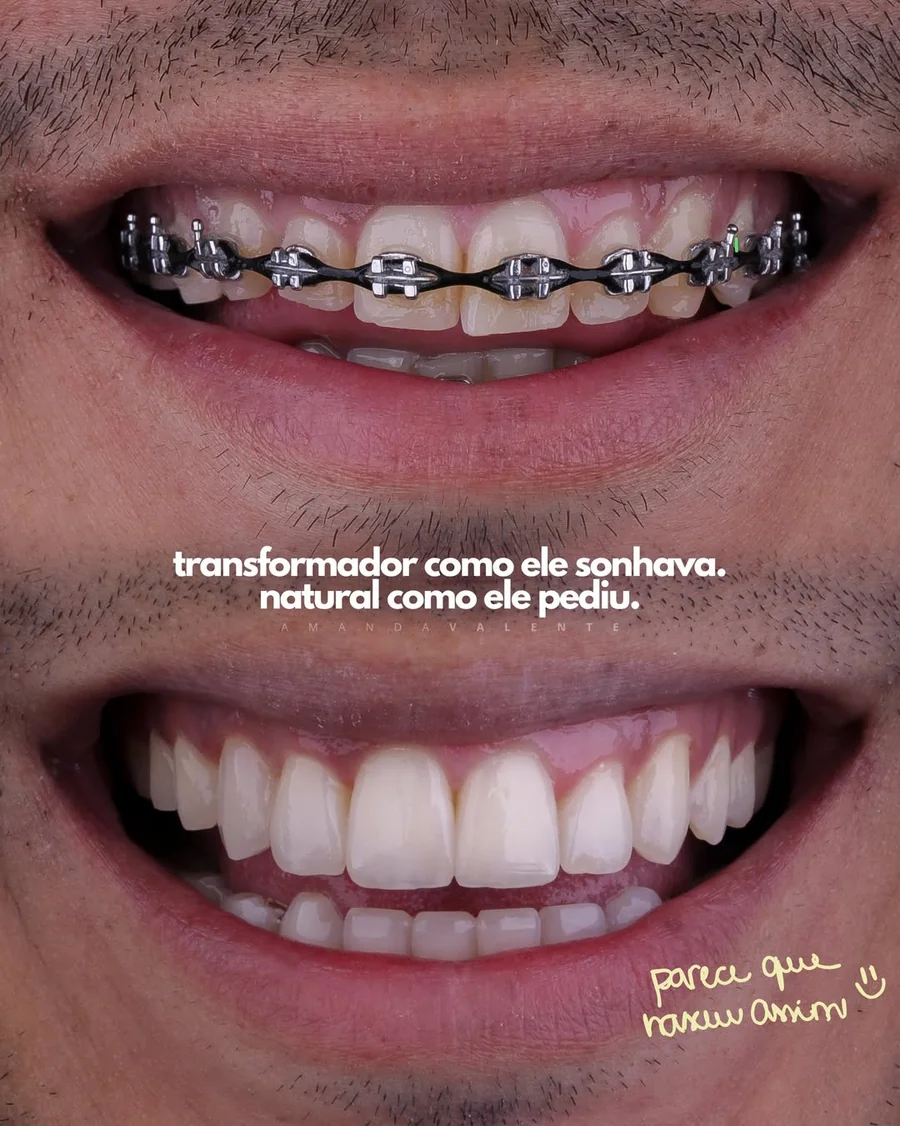 Antes e depois · ortodontia