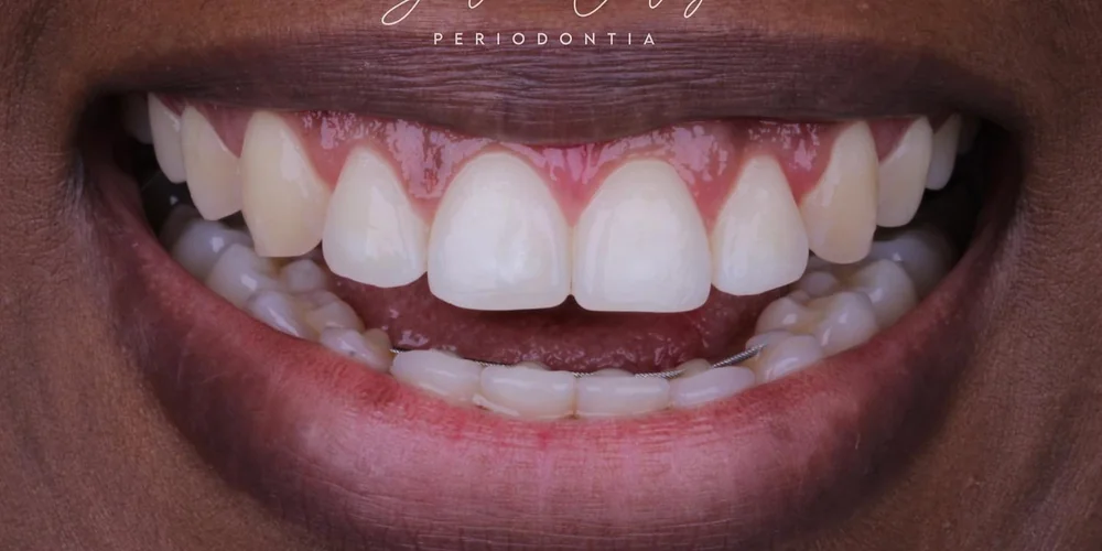 Resultado de periodontia · Valente Studio Oral