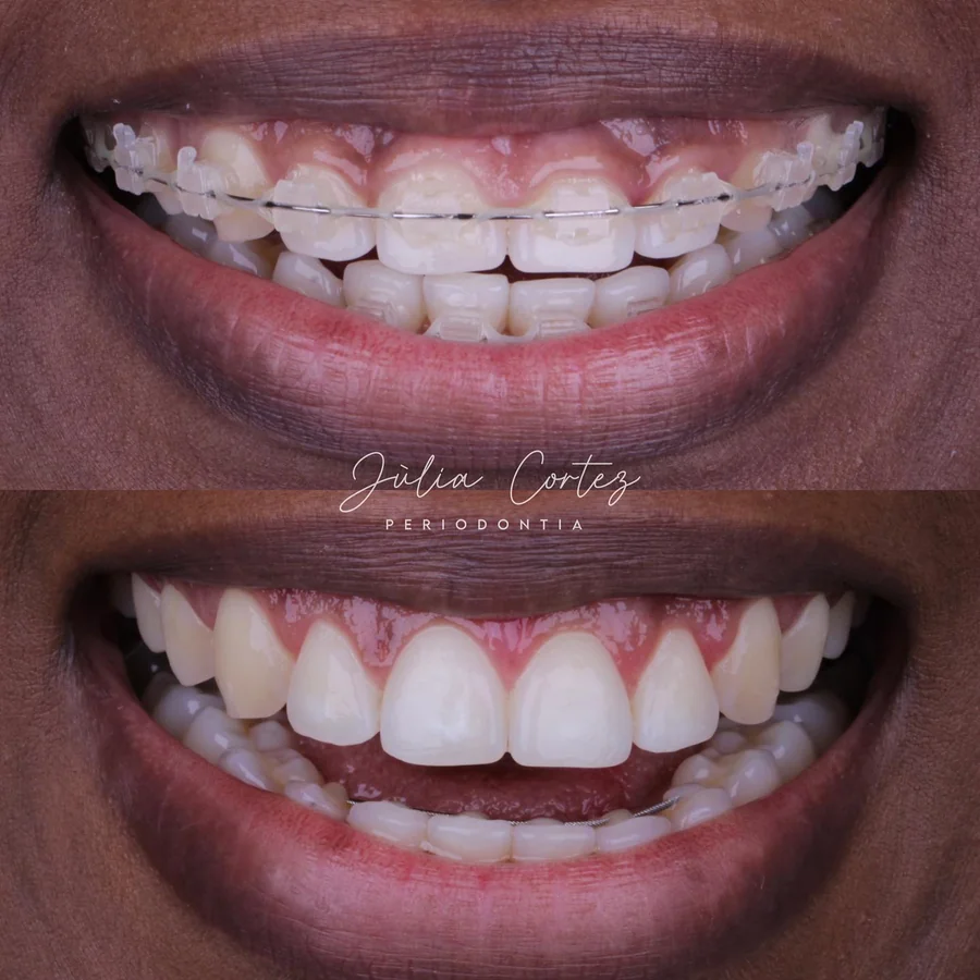 Transformação de sorriso